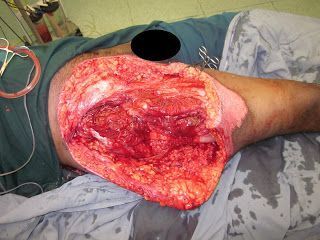 Name:  intra%20op%20pic%20-%20surgical%20debridement%20done.JPG
Views: 401
Size:  36.3 KB