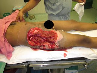 Name:  good%20granulation%20seen%20before%20skin%20graft.JPG
Views: 375
Size:  26.9 KB