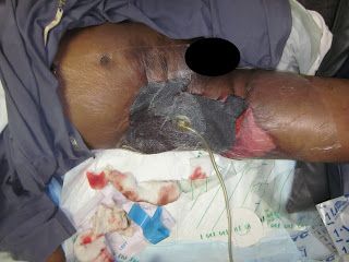 Name:  pressure%20wound%20therapy%20in%20progress.JPG
Views: 482
Size:  24.5 KB