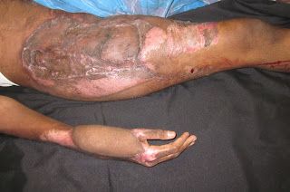 Name:  healed%20wound.JPG
Views: 377
Size:  20.4 KB
