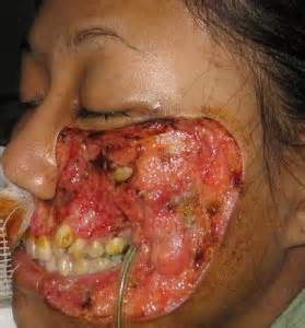 flesheatingbacteria2.jpg