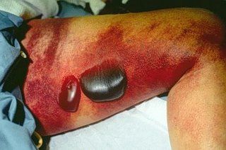 Name:  Necrotizing%20Fasciitis.jpg
Views: 394
Size:  18.1 KB