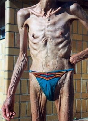 Name:  Anorexic%20woman%234.jpg
Views: 400
Size:  37.5 KB