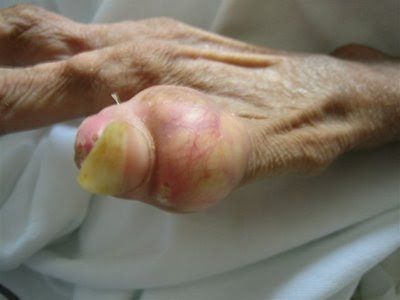 Name:  anorexia_hand-46yo%20woman%20%232.jpg
Views: 397
Size:  17.8 KB