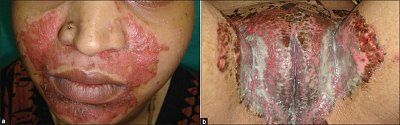 yeast-infection-image.jpg