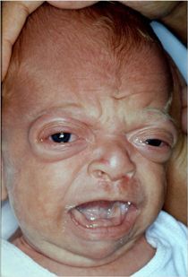 antley%20bixler%20face%20of%20new%20born.jpg
