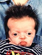 antley%20bixler%20syndrome1.jpg