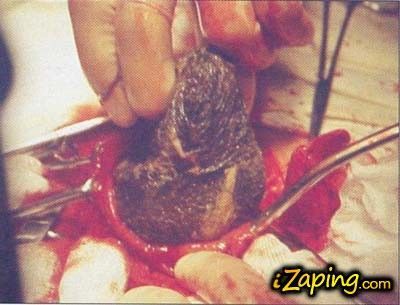 tricofagia.jpg
