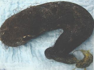 tricobezoares_tratamiento_manejo.jpg