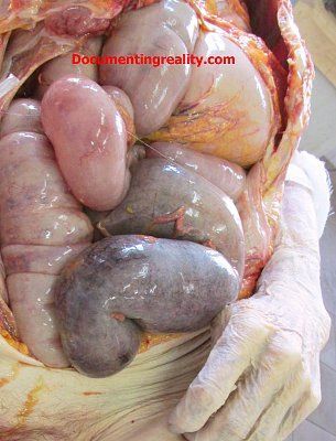gangreneofthesigmoidcolon1.jpg