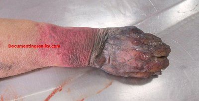 thrombosislgangrenehand11.jpg