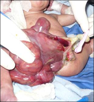 rare%20case%20of%20gastroschisis.jpg