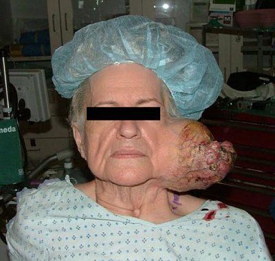 acinic-cell-adenocarcinoma.jpg