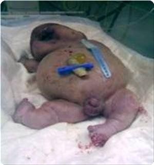 1305894651_foto_news_birth-defects_300_0.jpg