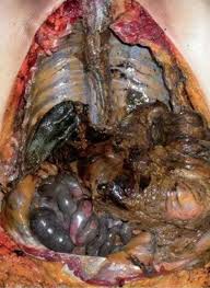 Name:  hydrolic%20acid%20burn.jpg
Views: 334
Size:  11.0 KB