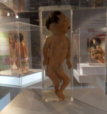 Name:  harlequin-type-icthyosis-ellis-pathological-museum-siriraj-medical-museum-bangkok-thailand.JPG
Views: 414
Size:  28.2 KB