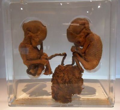 Name:  homozygous-twins-2-ellis-pathological-museum-siriraj-medical-museum-bangkok-thailand.JPG
Views: 418
Size:  30.9 KB
