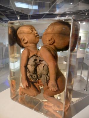 Name:  thoracopagus-conjoined-twins-2-ellis-pathological-museum-siriraj-medical-museum-bangkok-thailand.JPG
Views: 412
Size:  32.3 KB