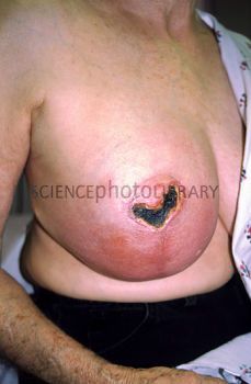 C0123518-Infection_after_breast_reconstruction-SPL.jpeg
