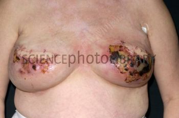 M1220466-Infection_following_breast_cancer_surgery-SPL.jpeg