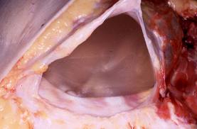 breast-implant-capsule-dr-barry-eppley-indianapolis.jpeg