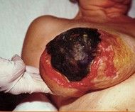 warfarin-necrosis.jpeg