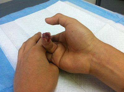 weight-lifting-accident-finger.jpg