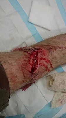 chainsaw-accident.jpg