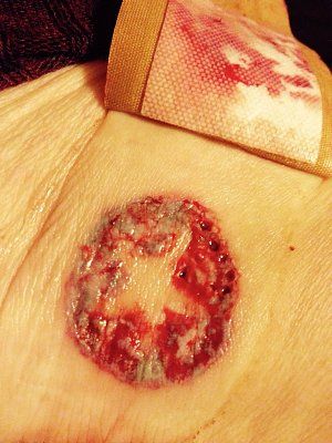 tattoo-laser-removal.jpg