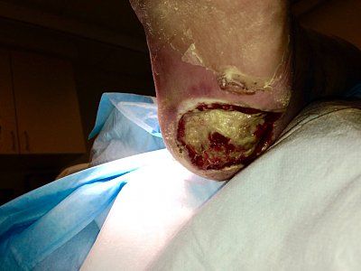 necrotic-blister.jpg