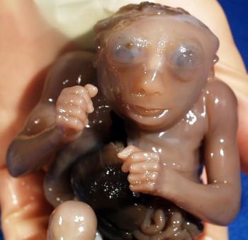 Name:  normal_dev_anencephaly_2.jpg
Views: 345
Size:  18.4 KB