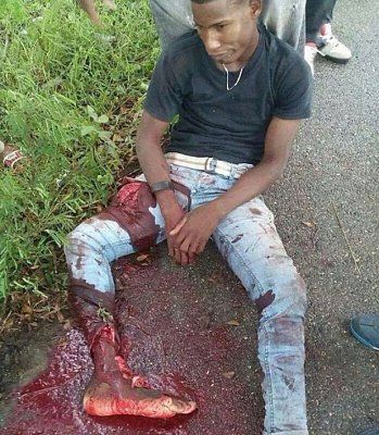 motorcycle-crash-bad-leg.jpg