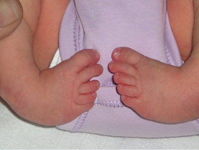 296324d1313162424-club-foot-club-foot.jpg