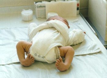 clubfoot-image.jpg
