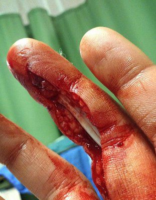 sliced-finger.jpg
