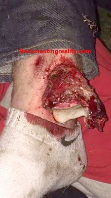 anklefracture1.jpg