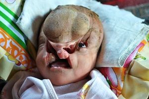 Name:  Bayi-cacat-fisik-Sofia.jpg
Views: 248
Size:  58.6 KB