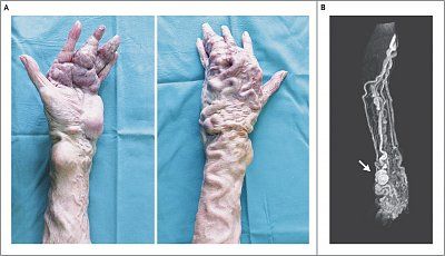 596695d1419846232-parkes-weber-syndrome-nejmicm1312948_f1.jpeg