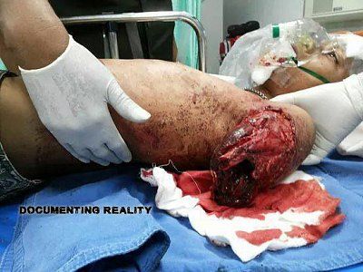 arm-ripped-off-motorcycle-01.jpg