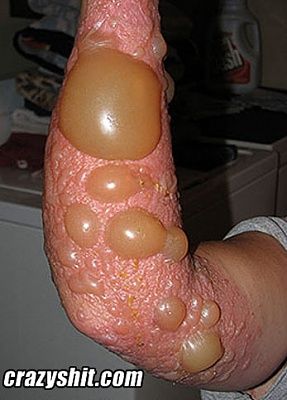 051309_chicken_pox.jpg