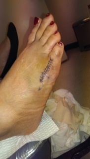 605649d1423446466-heels-booze-broken-foot-image.jpg