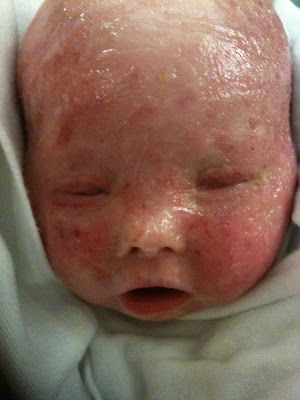 recurring%20staff%20infection%20infant.JPG