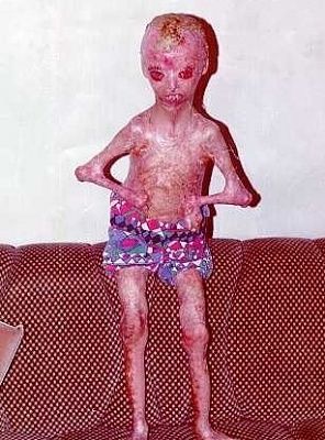 ogrish-dot-com-harlequinchild.jpg