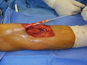 biceps_tendon_repair_surgery_photo-3.jpg
