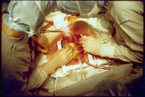 300px-Coronary_artery_bypass_surgery_Image_657B-PH.jpg