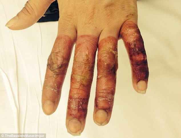 26C11A1400000578-3000044-Her_hands_are_in_the_process_of_healing_and_she_can_use_them_aga-m-52_1.jpg