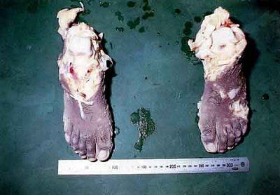 feet_recovered.jpg