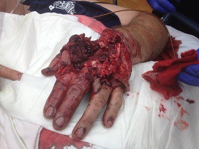 keltec-injury.jpg