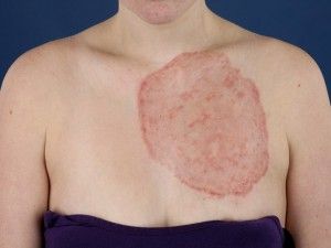 dermatomycosis-corporis-300x225.jpg