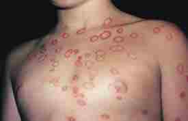 ringworm-on-body.jpg